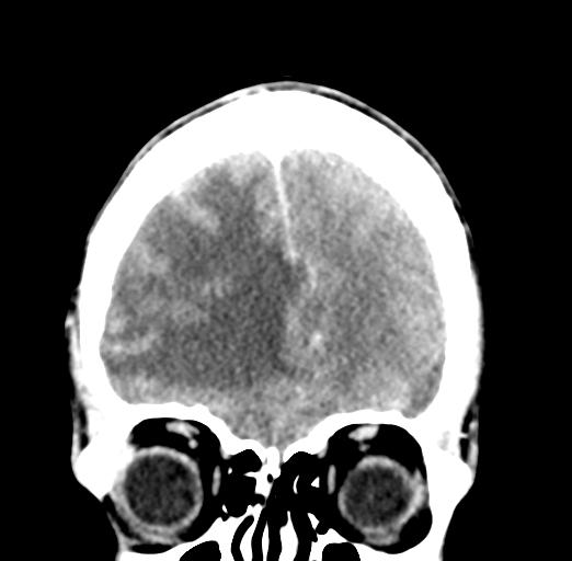 File:Cerebral abscess (Radiopaedia 60342-68008 Coronal C+ delayed 15).png