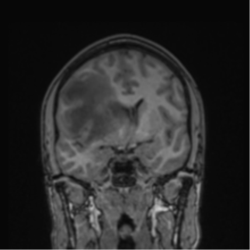 Cerebral abscess (Radiopaedia 60342-68009 Coronal T1 30).png
