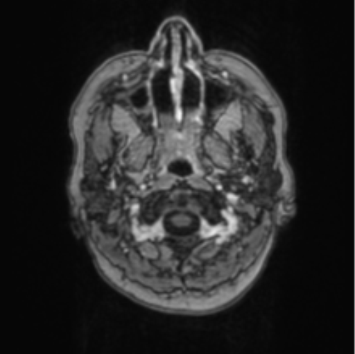 Cerebral abscess from pulmonary arteriovenous malformation (Radiopaedia 86275-102291 Axial T1 C+ 4).png