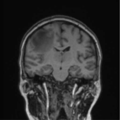Cerebral abscess from pulmonary arteriovenous malformation (Radiopaedia 86275-102291 Coronal T1 45).png