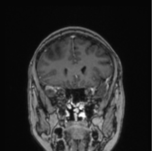 Cerebral abscess from pulmonary arteriovenous malformation (Radiopaedia 86275-102291 L 64).png