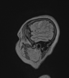 Cerebral abscess from pulmonary arteriovenous malformation (Radiopaedia 86275-102291 Sagittal FLAIR 65).png