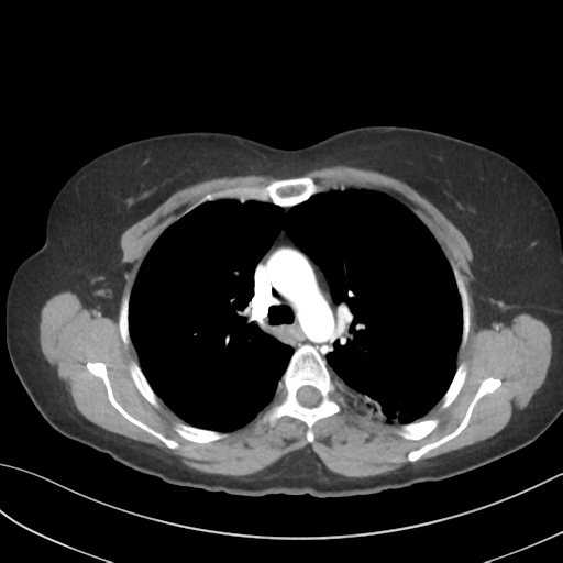 File:Cerebral abscess from pulmonary arteriovenous malformation (Radiopaedia 86275-102292 A 22).png