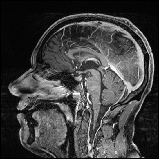Cerebral abscess with ventriculitis (Radiopaedia 78965-91878 Sagittal T1 C+ 91).jpg