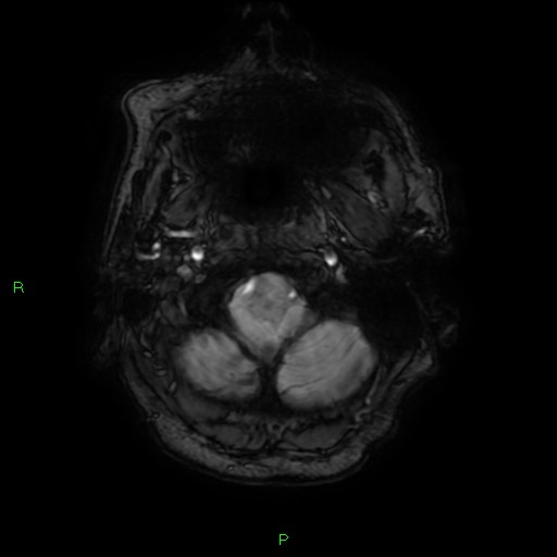 File:Cerebral amyloid angiopathy-associated lobar intracerebral hemorrhage (Radiopaedia 58376-65512 Axial SWI 3).jpg