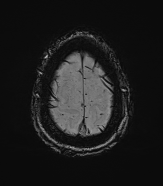 Cerebral amyloid angiopathy (Radiopaedia 46082-50433 Axial SWI 78).png