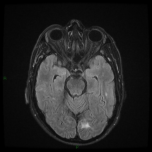 File:Cerebral amyloid angiopathy (Radiopaedia 77506-89664 Axial FLAIR 11).jpg