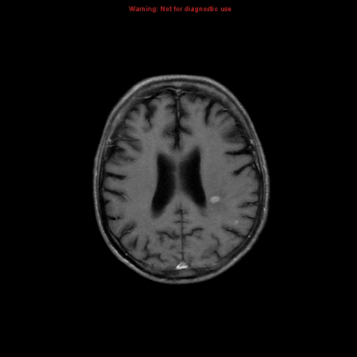 File:Cerebral and orbital tuberculomas (Radiopaedia 13308-13311 Axial T1 C+ 14).jpg