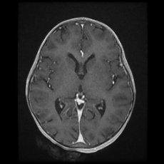 Cerebral and spinal tuberculosis (Radiopaedia 90489-107837 Axial T1 C+ 104).jpg
