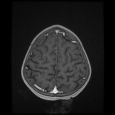 Cerebral and spinal tuberculosis (Radiopaedia 90489-107837 Axial T1 C+ 159).jpg