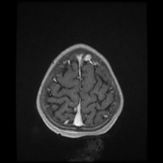File:Cerebral and spinal tuberculosis (Radiopaedia 90489-107837 Axial T1 C+ 170).jpg