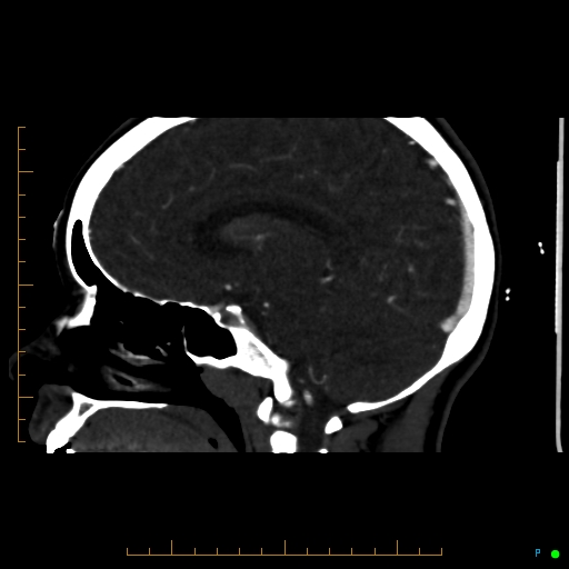 File:Cerebral arteriovenous malformation (AVM) (Radiopaedia 78162-90706 Sagittal CTA 45).jpg