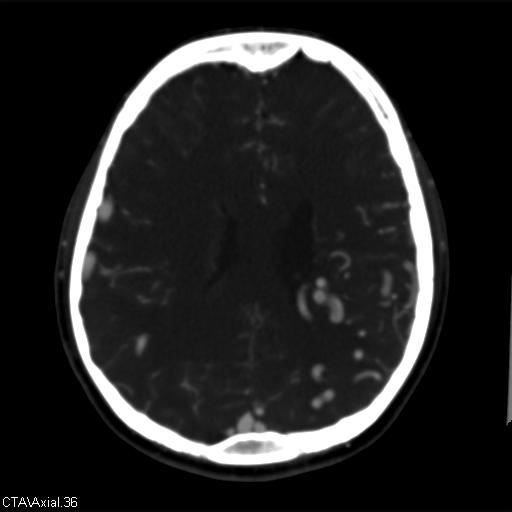 File:Cerebral arteriovenous malformation (Radiopaedia 28518-28759 B 36).jpg