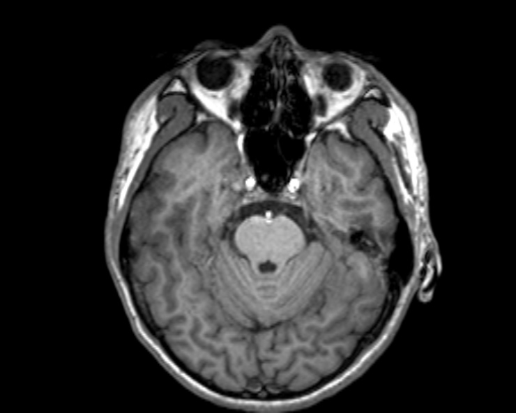 Cerebral arteriovenous malformation (Radiopaedia 30198-30813 Axial T1 41).jpg