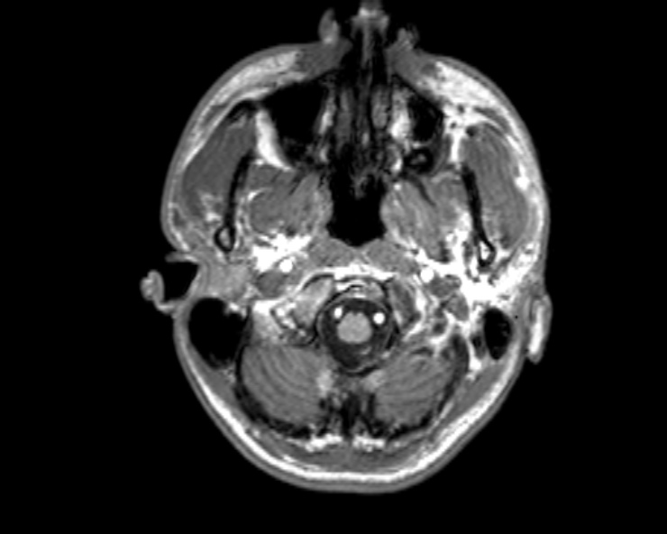 Cerebral arteriovenous malformation (Radiopaedia 30198-30813 Axial T1 51).jpg