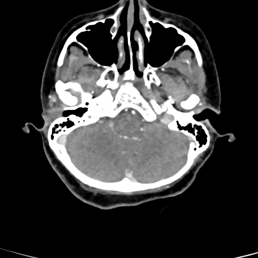 Cerebral arteriovenous malformation (Radiopaedia 73830-84645 B 81).jpg