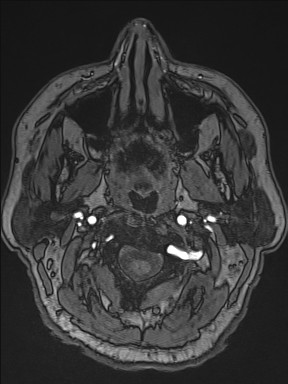 File:Cerebral arteriovenous malformation (Radiopaedia 84015-99245 Axial TOF 8).jpg