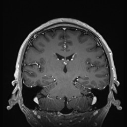 Cerebral arteriovenous malformation (Radiopaedia 84015-99245 Coronal T1 C+ 91).jpg
