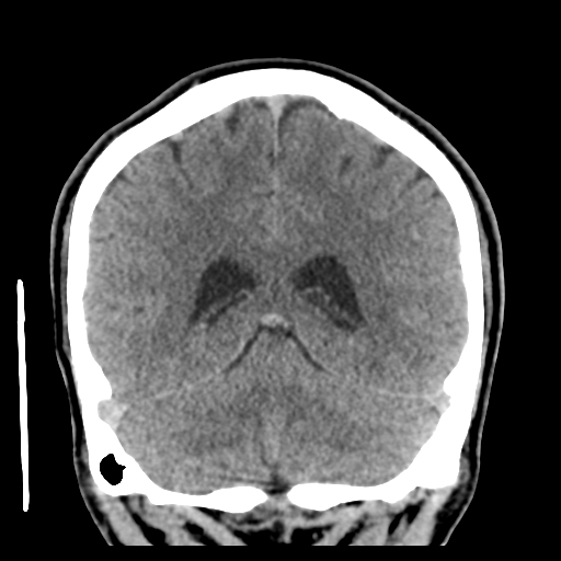 Cerebral arteriovenous malformation (Spetzler-Martin grade 2) (Radiopaedia 41262-44076 Coronal non-contrast 44).png