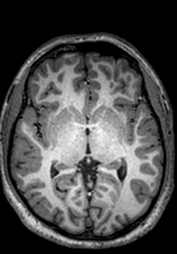Cerebral arteriovenous malformation at posterior body of corpus callosum (Radiopaedia 74111-84925 Axial T1 158).jpg
