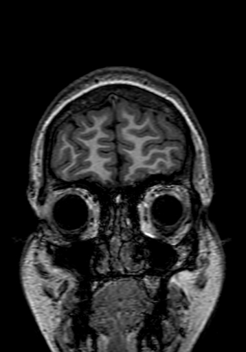 Cerebral arteriovenous malformation at posterior body of corpus callosum (Radiopaedia 74111-84925 Coronal T1 17).jpg