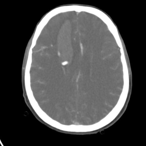 Cerebral arteriovenous malformation with hemorrhage (Radiopaedia 28773-29073 A 21).jpg