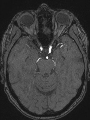 Cerebral arteriovenous malformation with hemorrhage (Radiopaedia 34422-35737 Axial MRA 30).png