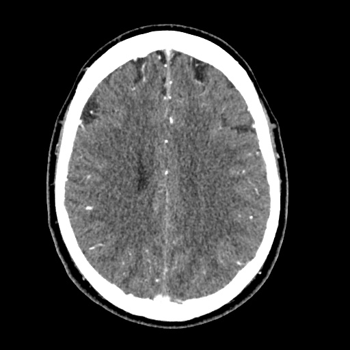 Cerebral arteriovenous malformation with lobar hemorrhage (Radiopaedia 35598-57216 A 42).jpg