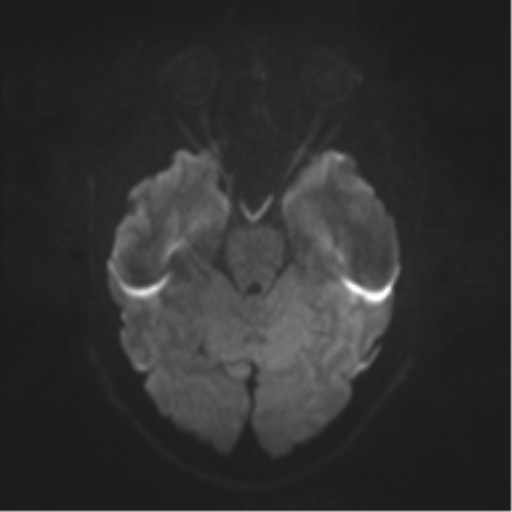 File:Cerebral cavernoma and development venous anomaly (Radiopaedia 37603-39482 Axial DWI 31).png