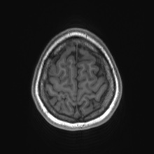 Cerebral cavernous venous malformation (Radiopaedia 70008-80021 Axial T1 82).jpg