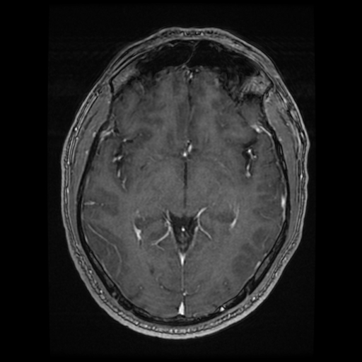 Cerebral cavernous venous malformation (Zabramski type II) (Radiopaedia 85511-101198 Axial T1 C+ fat sat 48).jpg