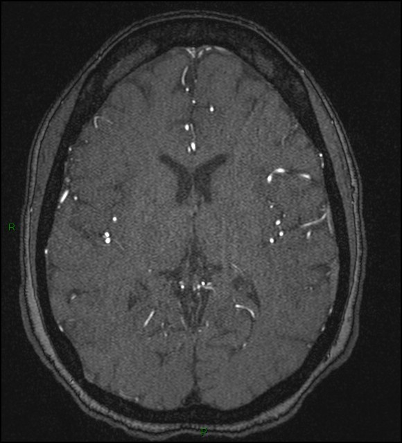 Cerebral fat embolism (Radiopaedia 35022-36525 Axial TOF 116).jpg
