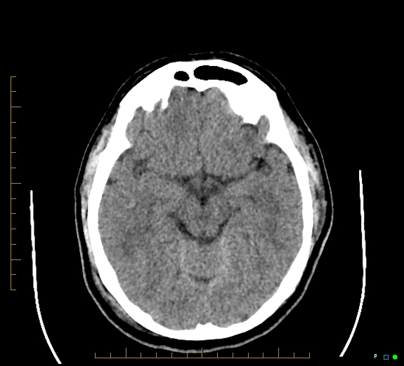 File:Cerebral fat embolism (Radiopaedia 85521-101220 Axial non-contrast 28).jpg