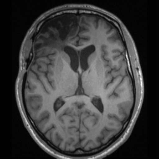 Cerebral hemorrhagic contusions- temporal evolution (Radiopaedia 40224-42757 Axial T1 40).png