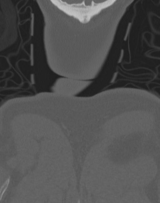 Cerebral hemorrhagic contusions and cervical spine fractures (Radiopaedia 32865-33841 Coronal bone window 88).jpg