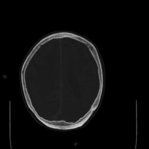 File:Cerebral metastases - breast primary (Radiopaedia 77653-89857 Axial bone window 77).jpg