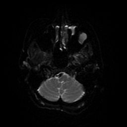 File:Cerebral metastases - melanoma (Radiopaedia 80972-94522 Axial DWI 70).jpg