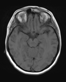 File:Cerebral metastases mimicking abscesses (Radiopaedia 45841-50131 Axial T1 12).png