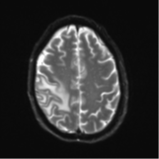 Cerebral metastasis - melanoma (Radiopaedia 54718-60954 Axial DWI 23).png
