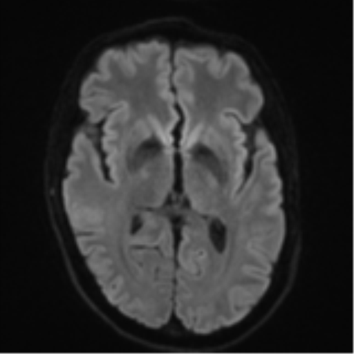 File:Cerebral metastasis - melanoma (Radiopaedia 54718-60954 Axial DWI 45).png