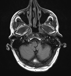File:Cerebral metastasis - melanoma (Radiopaedia 54718-60954 Axial FLAIR 5).png
