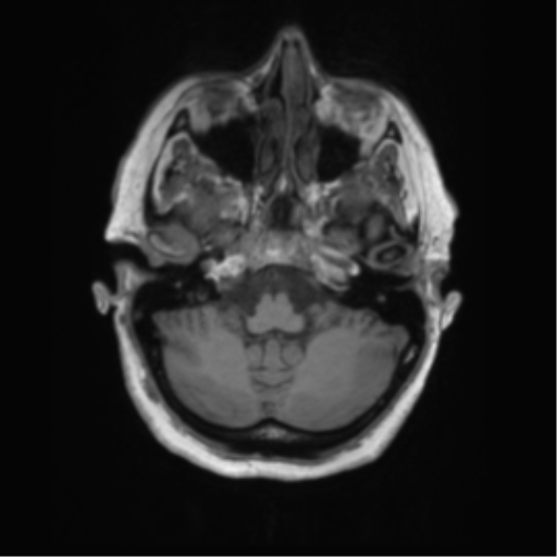 File:Cerebral metastasis mimicking glioblastoma (Radiopaedia 69155-78937 Axial T1 9).png