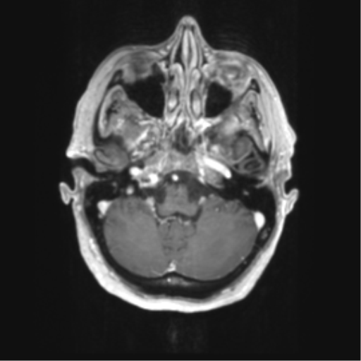 Cerebral metastasis mimicking glioblastoma (Radiopaedia 69155-78937 Axial T1 C+ 10).png