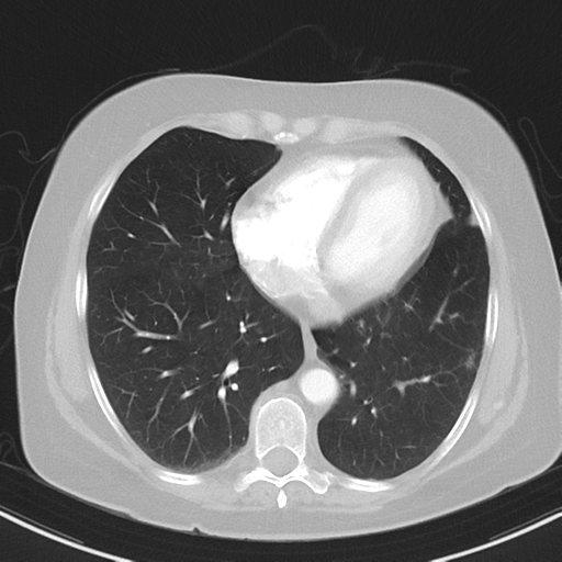 File:Cerebral metastasis mimicking glioblastoma (Radiopaedia 69155-78938 Axial lung window 32).png