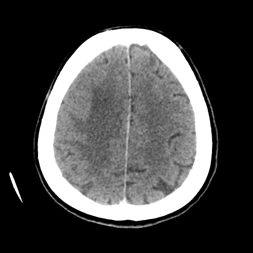 Cerebral metastasis to basal ganglia (Radiopaedia 81568-95412 Axial C+ delayed 44).png