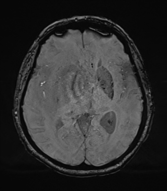 Cerebral metastasis to basal ganglia (Radiopaedia 81568-95413 Axial SWI 41).png