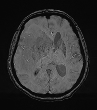 Cerebral metastasis to basal ganglia (Radiopaedia 81568-95413 Axial SWI 46).png