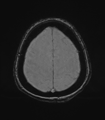 File:Cerebral metastasis to basal ganglia (Radiopaedia 81568-95413 Axial SWI magnitude 73).png