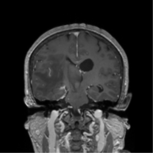File:Cerebral metastasis to basal ganglia (Radiopaedia 81568-95413 Coronal T1 C+ 21).png