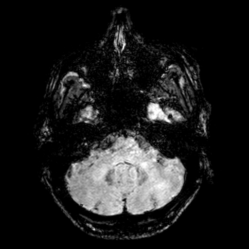 Cerebral parenchymal arteriovenous malformation (Radiopaedia 27280-27456 Axial SWI 13).jpg